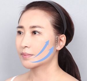 face lifting